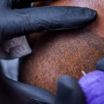 Micro haar pigmentatie Alkmaar