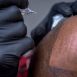Close up shot of scalp micro-pigmentation for bald men. Medical treatment for hair imitation. Afro American.