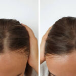 woman baldness hair before and after treatment