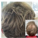 Volumebehandeling man