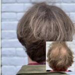 Volumebehandeling na haartransplantatie