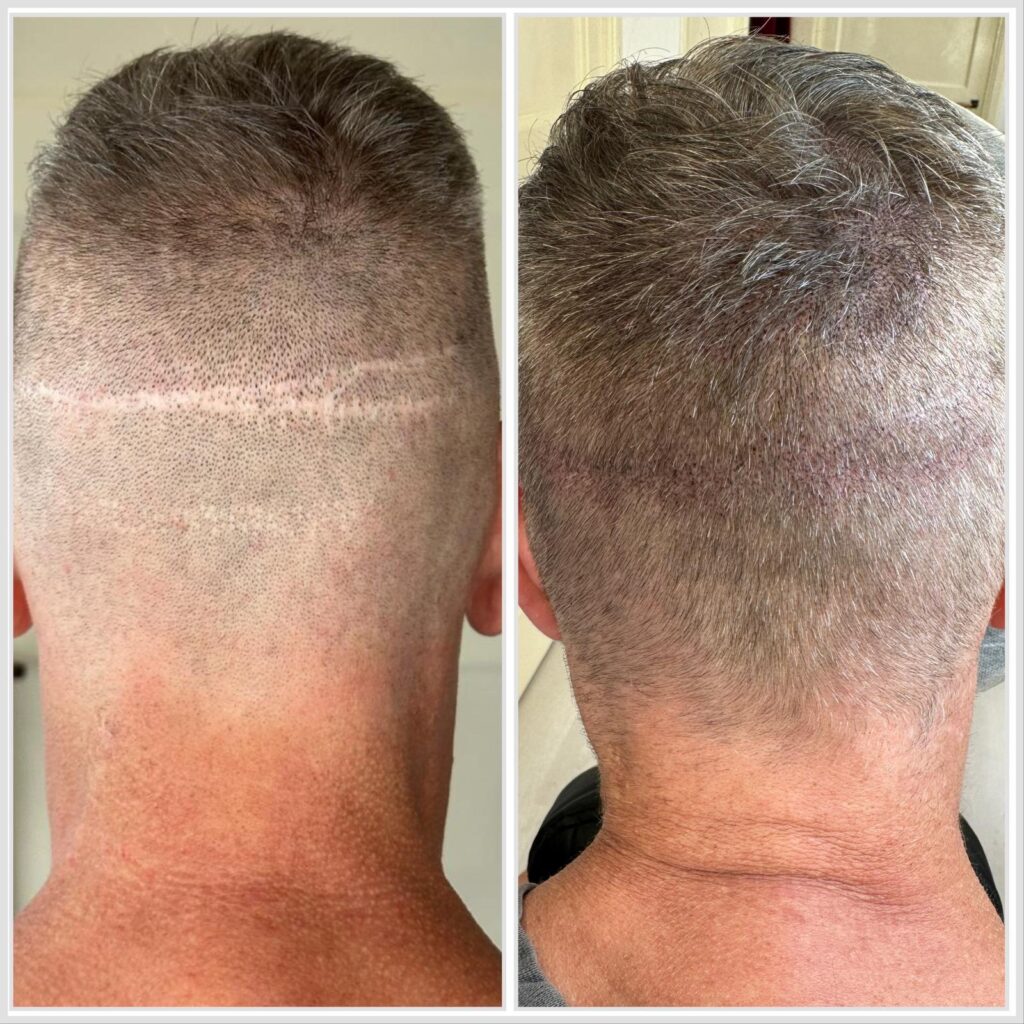 scalp pigmentatie met tattoo